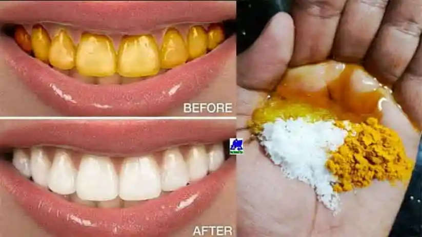 How to Naturally Whiten Your Teeth at Home, Kochi, News, Top Headlines, Naturally Whiten Teeth, Home, Health Tips, Health, Kerala News